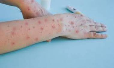 El Ministerio de Salud de informa la situación epidemiológica ante el alerta por viruela símica